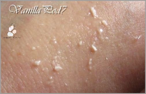 Niesamowite Efekty Bez Wyciskania Pryszczy!