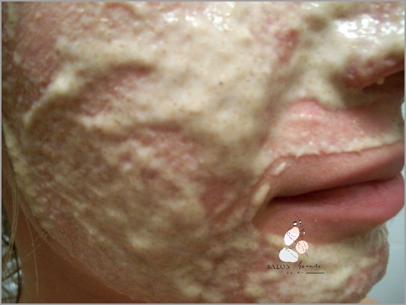 Niesamowite Efekty Maseczki Z Białka Na Wągry!