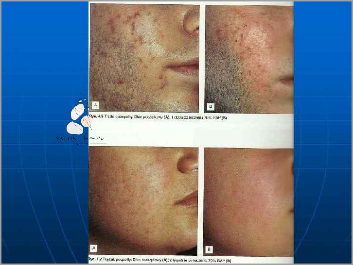 Odkryj, Co To Jest Peeling!