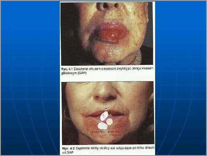 Odkryj, Co To Jest Peeling!