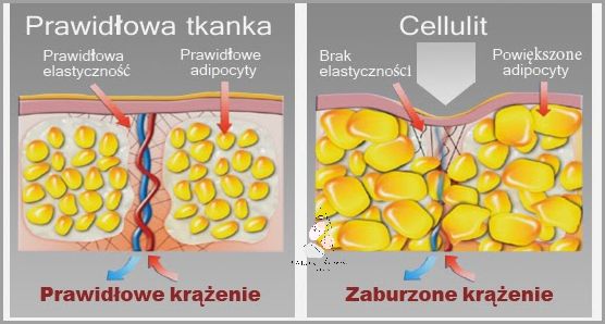Odkryj Skąd Się Bierze Cellulit!