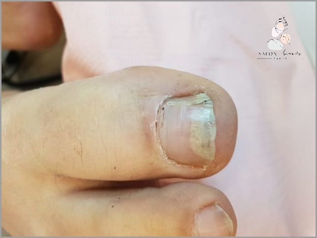 Onycholiza Po Hybrydzie: Jak Leczyć?