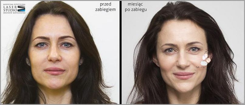 Opinie o opasce liftingującej na twarz!
