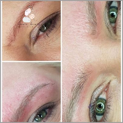 Peeling Weglowy Laserem - Opinie Użytkowników!