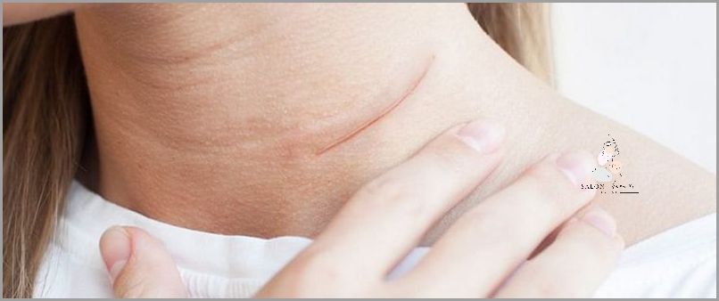 Plastry Na Blizny Po Cc - Nie Przegap!