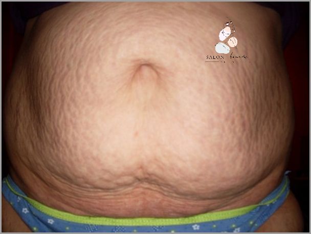 Pomocy! Ból Podbrzusza Po Miesiączce - Forum