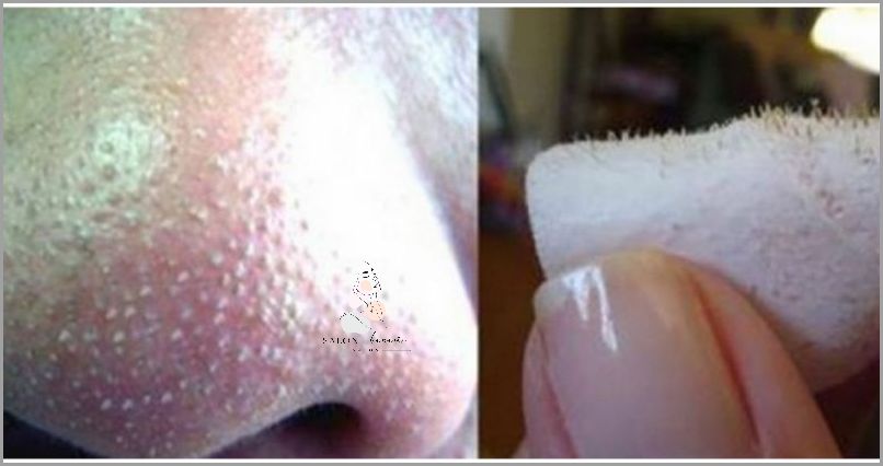 Poznaj Skuteczny Sposób Na Wągry Na Nosie: Youtube!