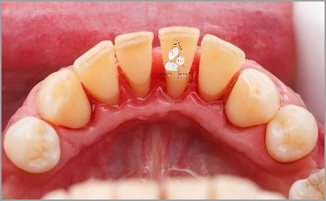 Przepiękna Zmiana Przed I Po Wybieleniu Odbytu!