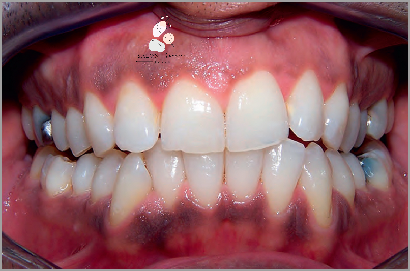 Przepiękna Zmiana Przed I Po Wybieleniu Odbytu!