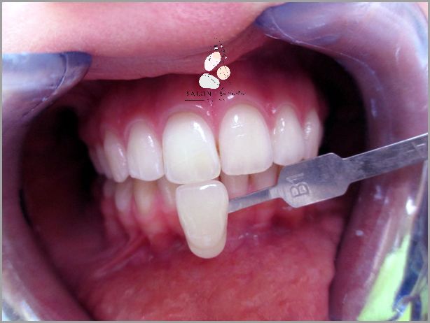 Przepiękna Zmiana Przed I Po Wybieleniu Odbytu!