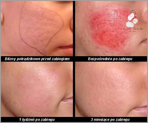 Przepiękne Efekty Dermapen Przed I Po!