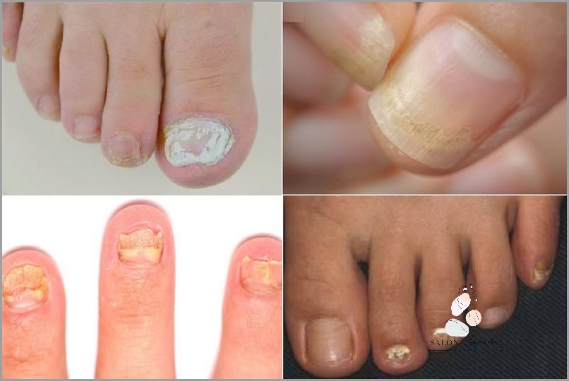 Ranking Lakierów Na Grzybicę Paznokci!