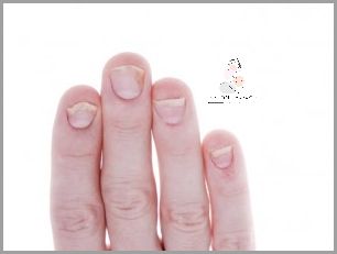 Sekretny Przepis na Leczenie Chorób Paznokci U Rąk!