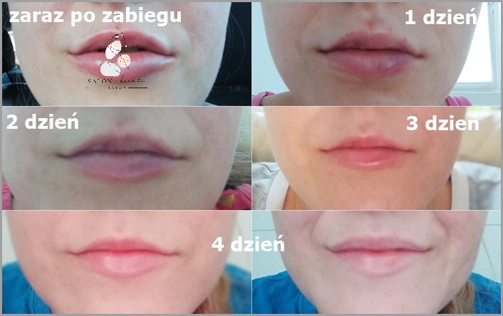 Siniaki Po Powiększaniu Ust - Czy To Norma? Siniaki Po Powiększaniu Ust - Czy To Norma?