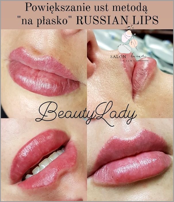 Siniaki Po Powiększaniu Ust - Czy To Norma? Siniaki Po Powiększaniu Ust - Czy To Norma?