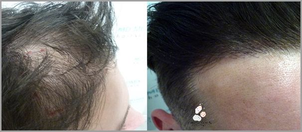 Skuteczna Metoda Przerzedzania Włosów Z Przodu Głowy!