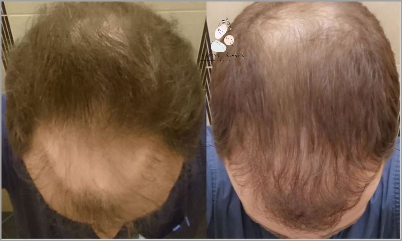 Skuteczna Metoda Przerzedzania Włosów Z Przodu Głowy!