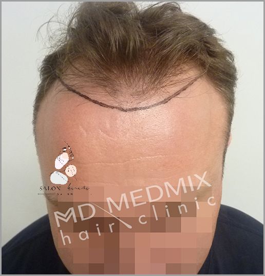 Skuteczna Metoda Przerzedzania Włosów Z Przodu Głowy!