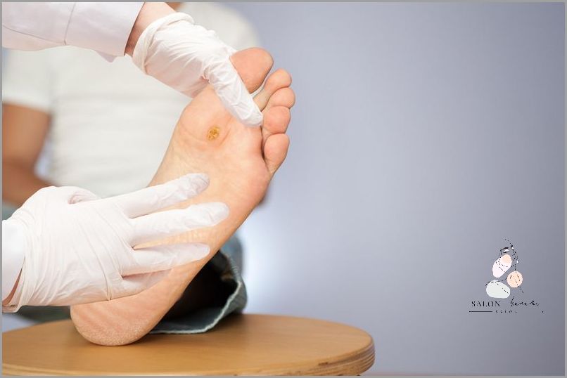 Skuteczne Domowe Sposoby Na Kurzajki!