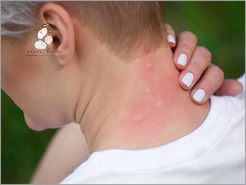 Skuteczne Leczenie Łojotokowego Zapalenia Skóry!