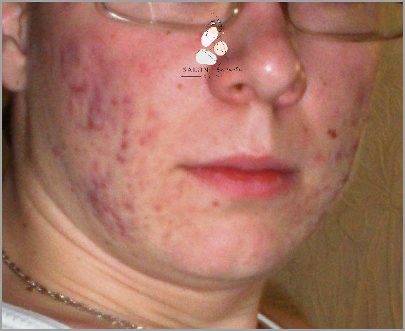 Suche Plamy Na Twarzy: Przerażające Objawy!