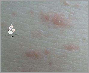 Szokujące Zdjęcia Łupieżu Różowego Giberta!