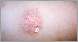 Szokujące Zdjęcia Łupieżu Różowego Giberta!