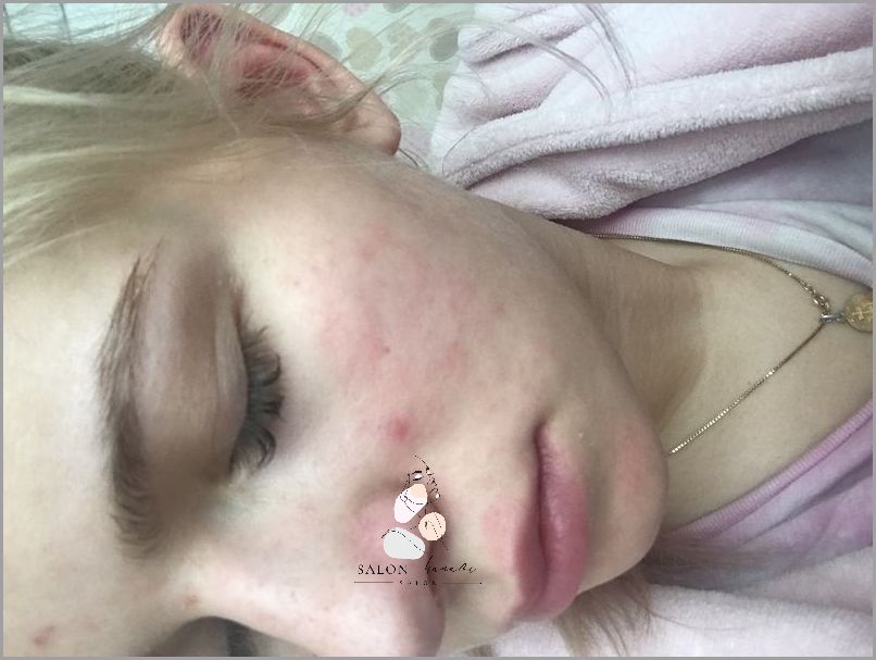 Ujawniamy: Plamy Wątrobowe Na Twarzy!