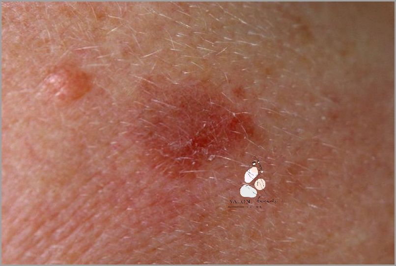 Ujawnione: Znamię Łojowe Na Skórze Głowy!