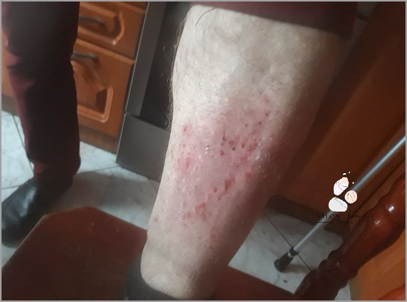 UWAGA! Fioletowe Plamy Na Nogach - Co To?