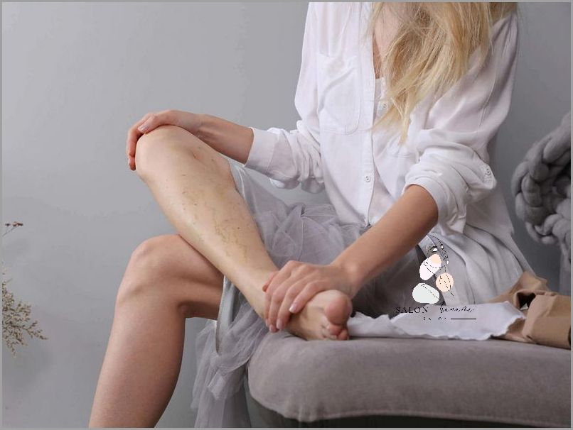 Uwaga: Pękające Naczynka Na Nogach!