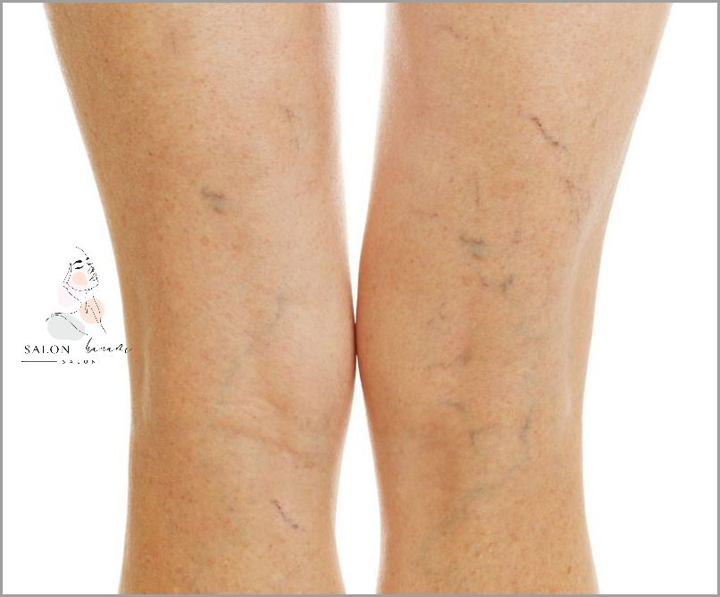 Uwaga: Pękające Naczynka Na Nogach!