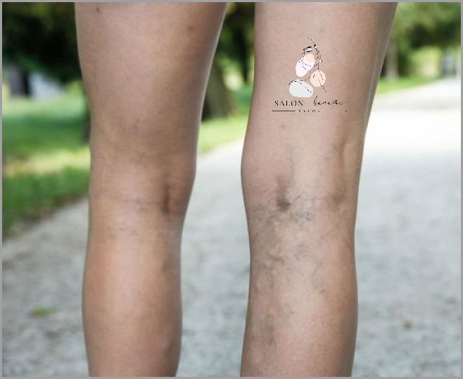 Uwaga: Pękające Naczynka Na Nogach!