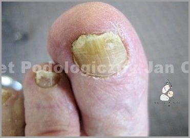 Uwaga! Pęknięty Paznokieć U Nóg - Co dalej? Uwaga! Pęknięty Paznokieć U Nóg - Co dalej?