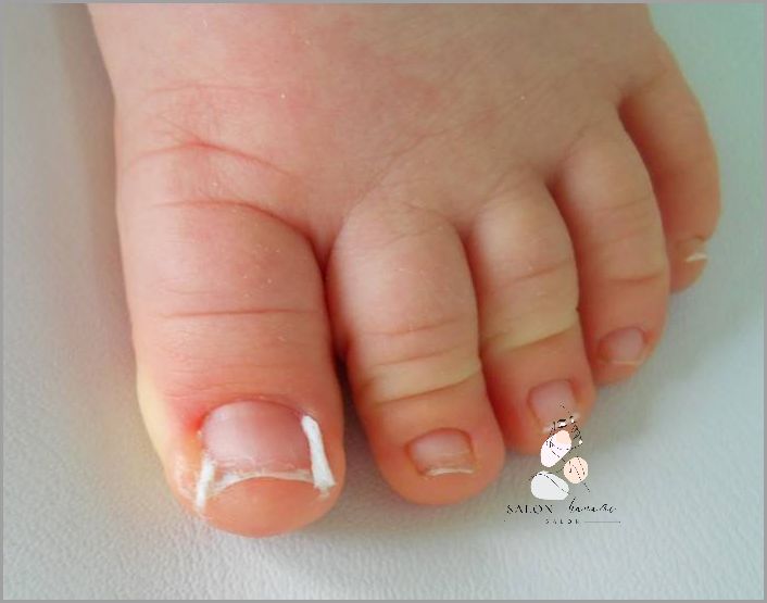 Uwaga! Pęknięty Paznokieć U Nóg - Co dalej? Uwaga! Pęknięty Paznokieć U Nóg - Co dalej?