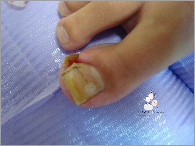 Uwaga! Pęknięty Paznokieć U Nóg - Co dalej? Uwaga! Pęknięty Paznokieć U Nóg - Co dalej?