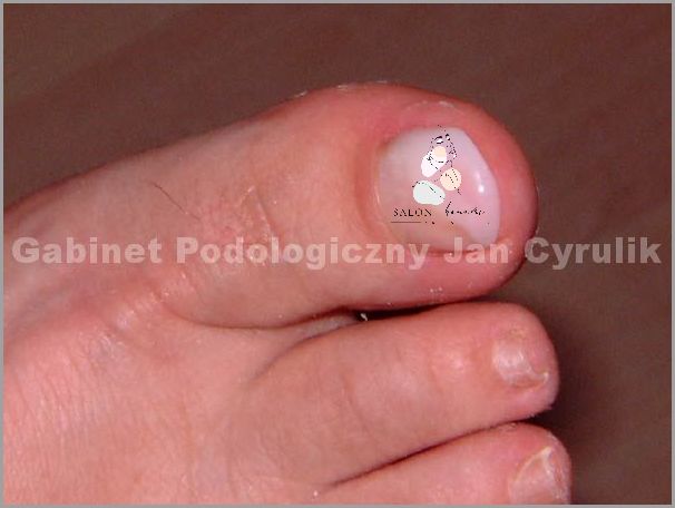 Uwaga! Pęknięty Paznokieć U Nóg - Co dalej? Uwaga! Pęknięty Paznokieć U Nóg - Co dalej?