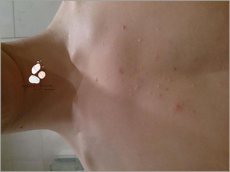 Uwaga! Plamy na Klatce Piersiowej - Sprawdź Czym Są!