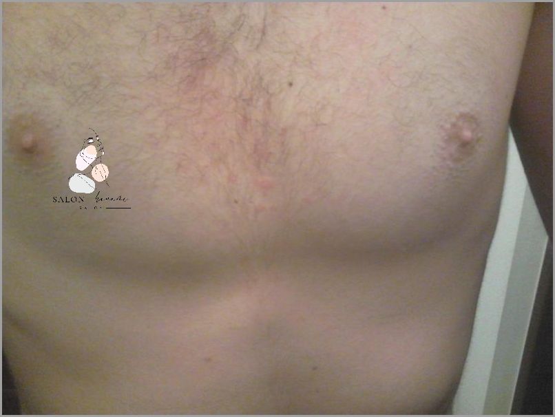 Uwaga! Plamy na Klatce Piersiowej - Sprawdź Czym Są!