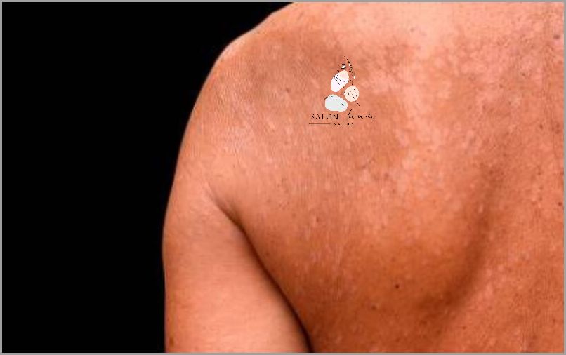 Uwaga! Plamy na Klatce Piersiowej - Sprawdź Czym Są!