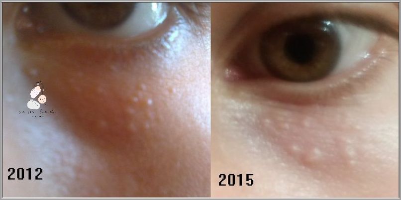 Uwaga! Pryszcz Na Wardze Sromowej! Uwaga! Pryszcz Na Wardze Sromowej!