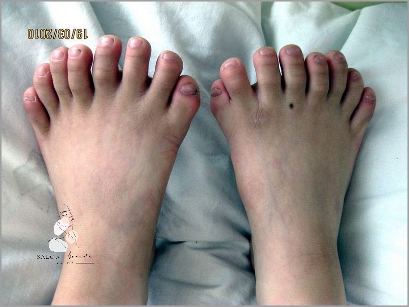 Uzależnienie od Swędzących Palców U Rąk!