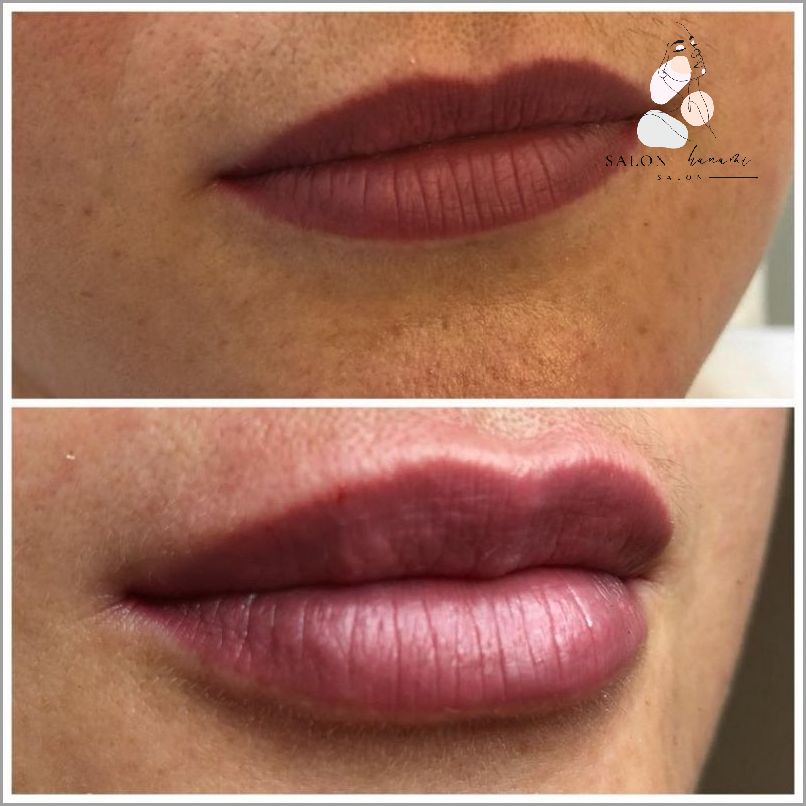 Zadziwiające Efekty Po Podaniu Kwasu Hialuronowego!