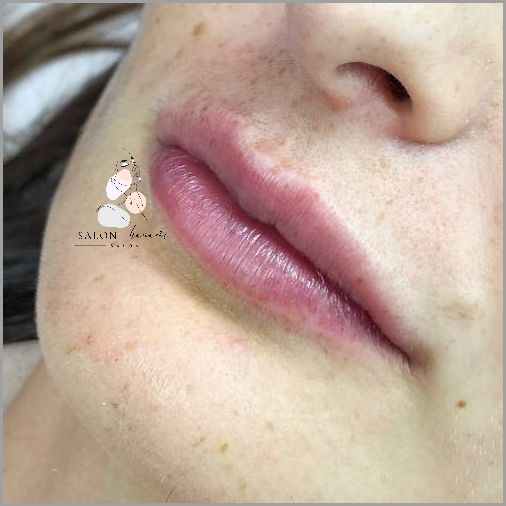 Zadziwiające Efekty Po Podaniu Kwasu Hialuronowego!