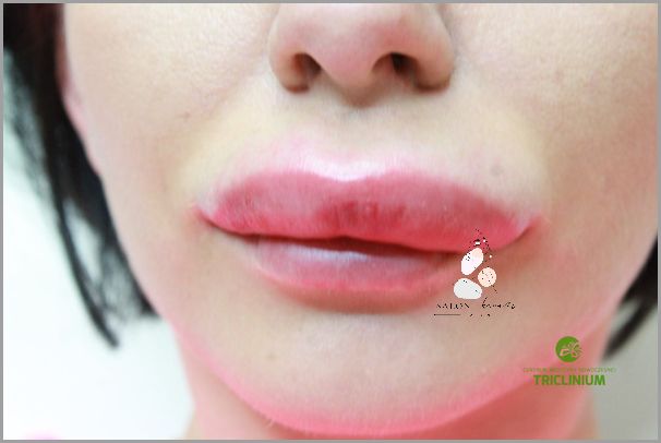 Zadziwiające Efekty Po Podaniu Kwasu Hialuronowego!