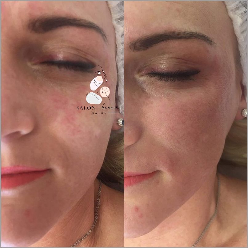 Zadziwiające Efekty Po Podaniu Kwasu Hialuronowego!