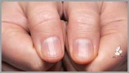 Złamany Paznokieć W Połowie Płytki - Co Zrobić?