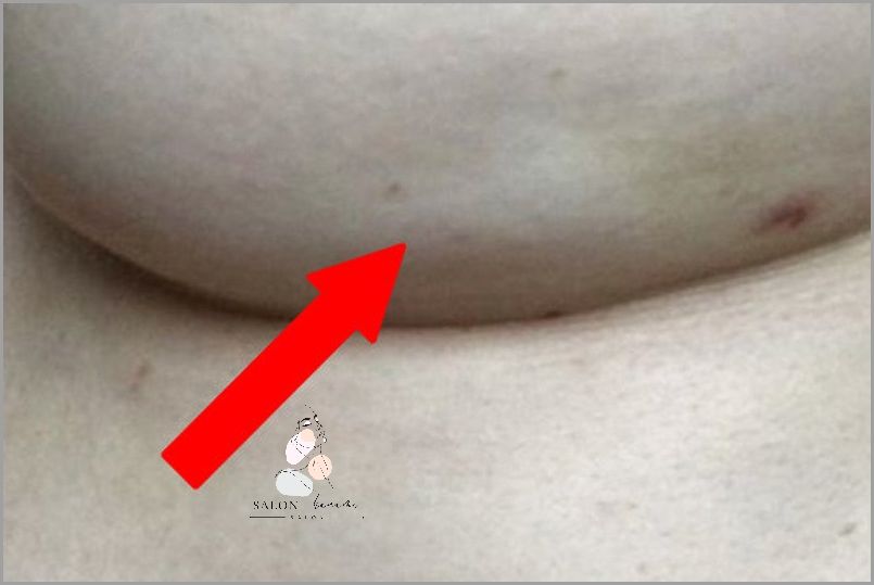 Zaskakujące Zdjęcia Plam Na Piersiach!