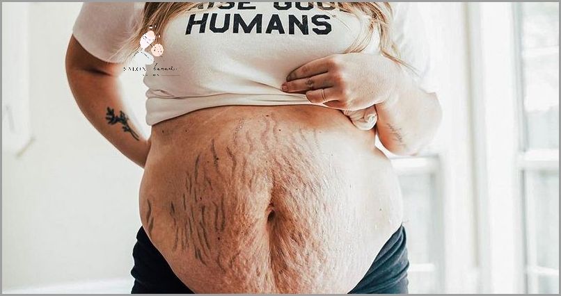 Zaskoczeni? Obwisła Skóra Na Brzuchu Po Ciąży!