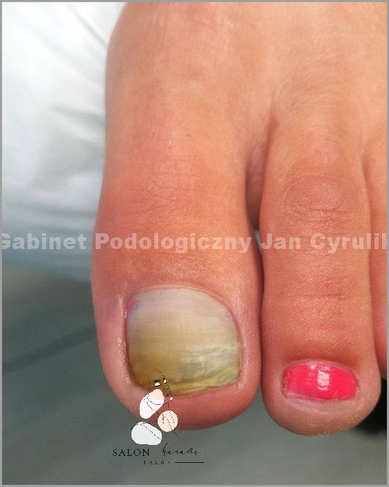 Zdjęcia Łuszczycy Paznokci i Grzybicy!